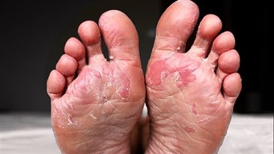 احذر .. خطر يهدد صحتك موجود في الجوارب