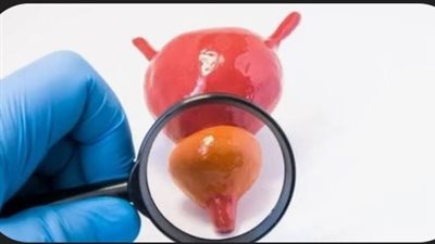 اكتشاف علمي لأحد «محركات» سرطان البروستاتا... يمهد لعلاجات أكثر دقة