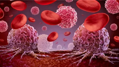 النظام الغذائي الغني بالدهون يزيد خطر الإصابة بسرطان الكبد