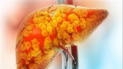 تحذير جديد يربط بين حمية الكيتو وزيادة خطر الإصابة بسرطان الكبد