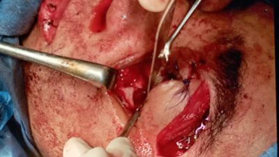  الفريق الطبي بمستشفى تمي الأمديد ينقذ حياة شاب من إصابات بالغة في الرأس والوجه