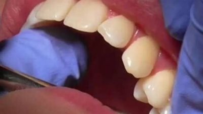 «تعطيل قنوات التواصل بين الميكروبات».. حيلة جديدة للتصدي لتسوس الأسنان