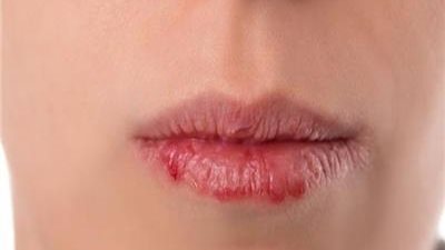 ودّعي تشقق الشفاه في الشتاء.. طرق طبيعية لترطيبها
