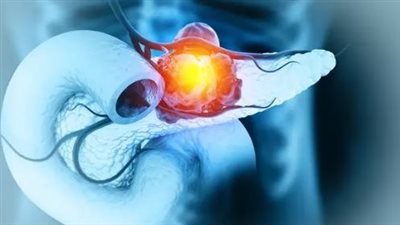 الكشف عن جينات ترتبط بخطر الإصابة بسرطان البنكرياس