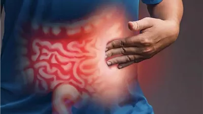 النظام الغذائي المثالي لمرضى الالتهاب المعوي المزمن