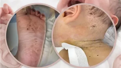 جريمة مروعة.. أم توخز رضيعها بالإبر 600 مرة لعقابه والسلطات تدخل