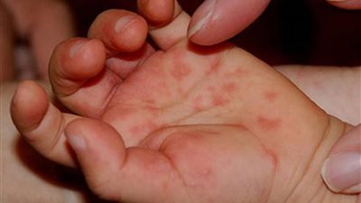 أضرار تناول المضادات الحيوية في علاج فيروس كوكساكي