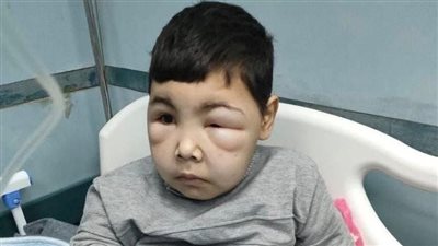 محافظ البحيرة توجة برعاية طفل يعاني من فشل  كلوي