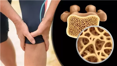 باحثون يحددون سلاح فعال ضد هشاشة العظام