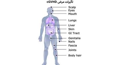 في ضوء اليوم العالمي لمرضى الطرد العكسي ضد النخاع