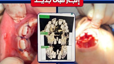 صحة البحيرة تنجح في خلع سن زائد مدفون بالفك العلوي بتدخل جراحي متقدم