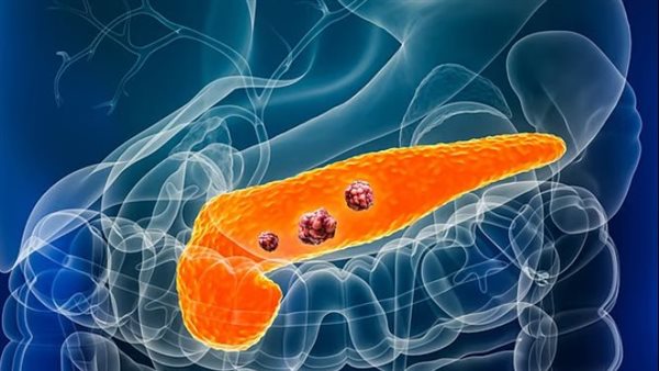 علماء يكتشفون إشارة إنذار مبكر لسرطان البنكرياس