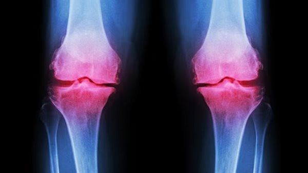 مكمل ألياف بسيط يساعد على تخفيف آلام التهاب المفاصل