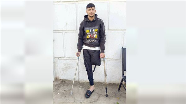 طرف صناعى للقدم ينقذ «محمد» من الإعاقة