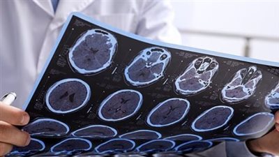 دراسة حديثة ترصد روتين يزيد احتمالية وفاة مرضى التصلب المتعدد