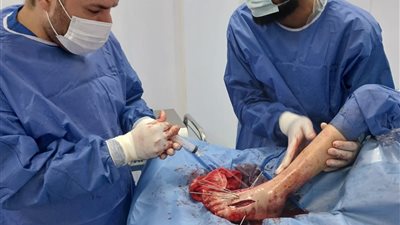 تدخل جراحي ينقذ قدم طفل من مضاعفات خطيرة بمستشفى طلخا