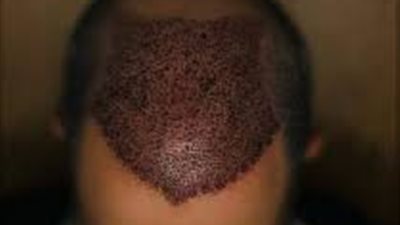 حكم زراعة الشعر للرجال والنساء والأحكام المترتبة على ذلك كالغسل وغيره