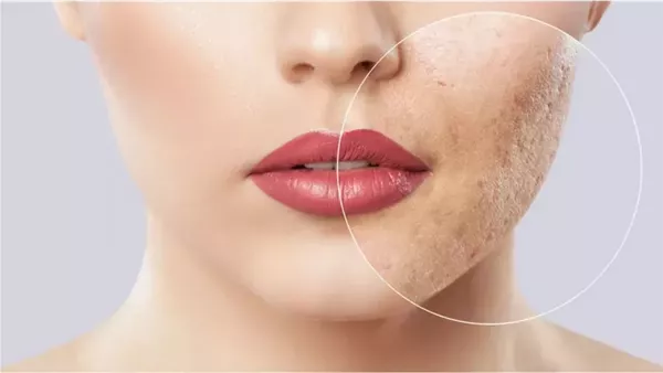 مشروبات تدمر بشرتك.. عادات تسبب ظهور الحبوب والتجاعيد