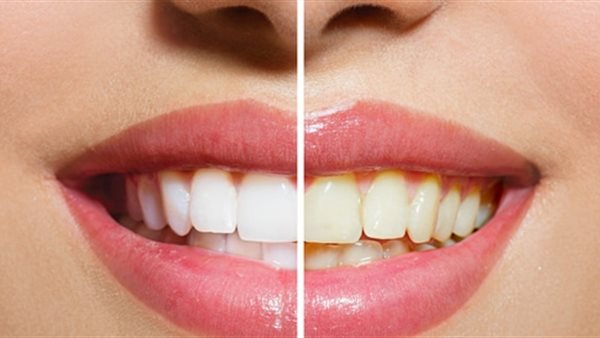 أطعمة بسيطة تعزز بياض الأسنان طبيعيًا.. تعرف عليها