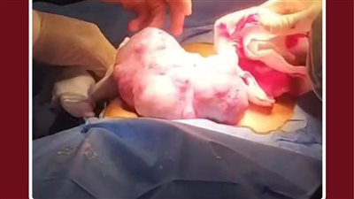استئصال ورم خبيث يزن 2 كجم من طفلة بعمر 10 سنوات بطنطا