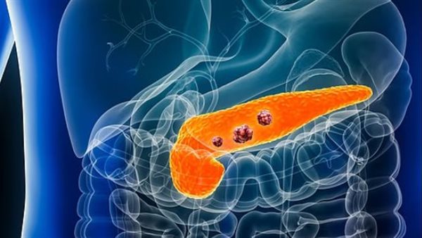 دواء جديد يمنح الأمل لمرضى سرطان البنكرياس القاتل