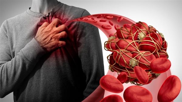 عادة بسيطة يوميًا قد تقلل خطر الجلطات.. ماذا يقول الأطباء؟