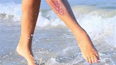 لدغات قنديل البحر تتطلب تدخلا سريعا لتخفيف الألم ومنع المضاعفات