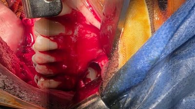 جراحة دقيقة تعيد بناء الوجه بمستشفى شريني