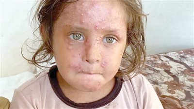 غزة قنبلة بيولوجية تهدد العالم