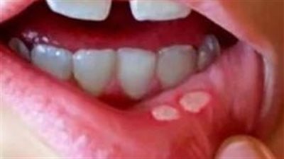 وصفات طبيعية فعّالة لعلاج فطريات الفم في الصيف