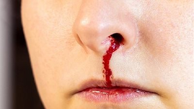 احذر.. نزيف الأنف لدى كبار السن قد يكون علامة على الجلطة الدماغية