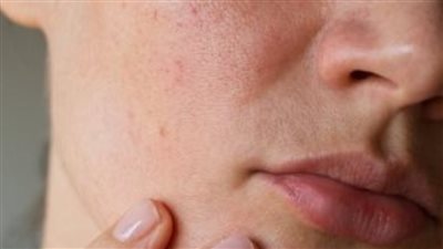وصفات طبيعية تساعد على التخفيف من ندبات البشرة