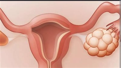 علاج فعال لتكيس المبياض