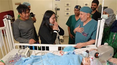 نجاح عملية فصل التوأم الملتصق الفلبيني 