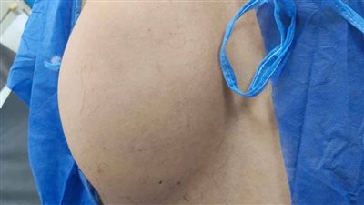 السعديين النموذجي ينجح في استئصال ورم دهني لمريض رفضت مستشفيات علاجه