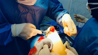 استئصال ورم دموي بمستشفى مشتول السوق المركزي وإنقاذ مريضة من مضاعفات خطيرة