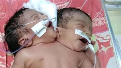  وضعت امرأة مولودًا برأسين فهل يرث ميراث شخص واحد أم ميراث شخصين؟