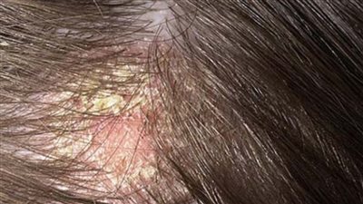 وصفات طبيعية قد تساعد في تخفيف قشرة شعر الأطفال.. العناية اللطيفة هي الأساس