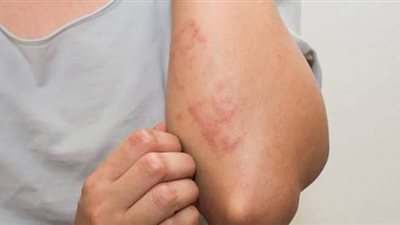 طبيبة توضح أعراض حساسية الشمس وطرق الوقاية منها