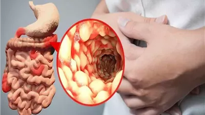 خبراء يكشفون غذاء مفاجئ يساعد في تهدئة التهاب الأمعاء