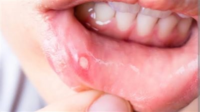 وصفات طبيعية تساعد في علاج تقرحات الفم.. طرق بسيطة لتخفيف الألم وتسريع الشفاء