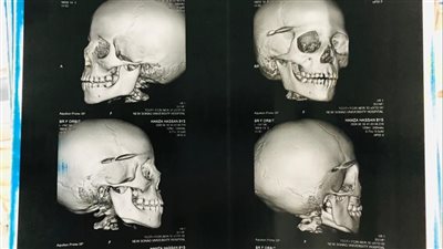 استخراج رصاصة طائشه من مخ طفل وإنقاذه دون مضاعفات بمستشفى سوهاج الجامعي 