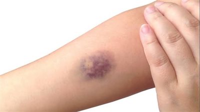 كدمات تظهر فجأة.. أسباب ظهور العلامات الزرقاء على الجلد