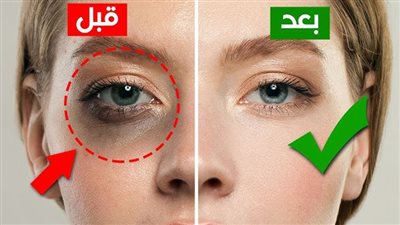 وصفات للتخفيف من اسمرار تحت العين.. بين العناية المنزلية والنصائح الطبية