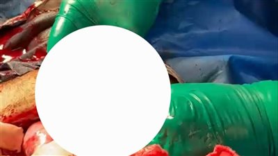 اكتشاف نادر داخل غرفة العمليات.. فريق طبي ببلبيس ينقذ شابة حامل من نزيف قاتل
