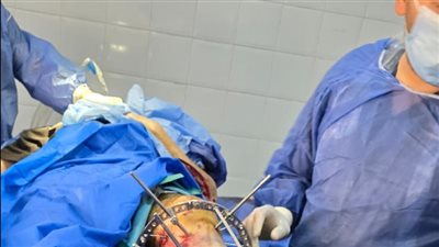 «إليزاروف» يفتح بابًا جديدًا للجراحات الدقيقة بأولاد صقر