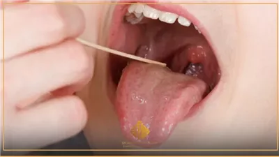 معلومات مهمة يجب اتباعها بعد إجراء عملية استئصال اللوز