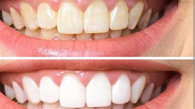 طرق تنظيف وتلميع الأسنان من الاصفرار.. خطوات بسيطة لابتسامة أكثر إشراقًا