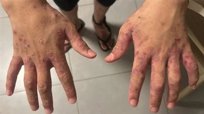نادي الأسير الفلسطيني: إصابة 10 أسيرات بالجرب في سجن الدامون الإسرائيلي