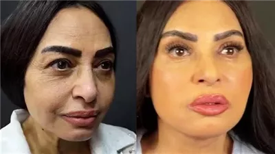 سلوى خطاب تتحدث عن عمليات التجميل وتشارك جمهورها تفاصيل رحلتها مع التجميل
